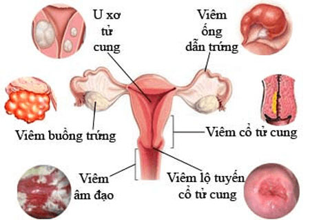 Các loại bệnh sản phụ khoa thường gặp
