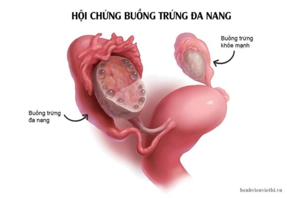 Ảnh mô tả hội chứng đa nang buồng trứng 