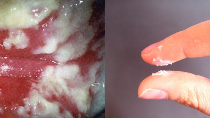 Viêm âm đạo do nấm Candida với khi hư bã đậu và ngứa rát