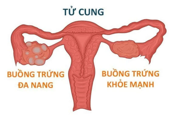 tử cung