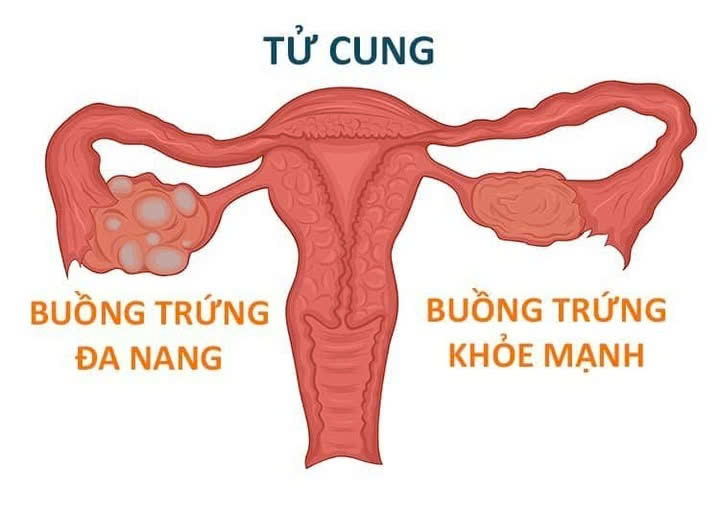 tử cung
