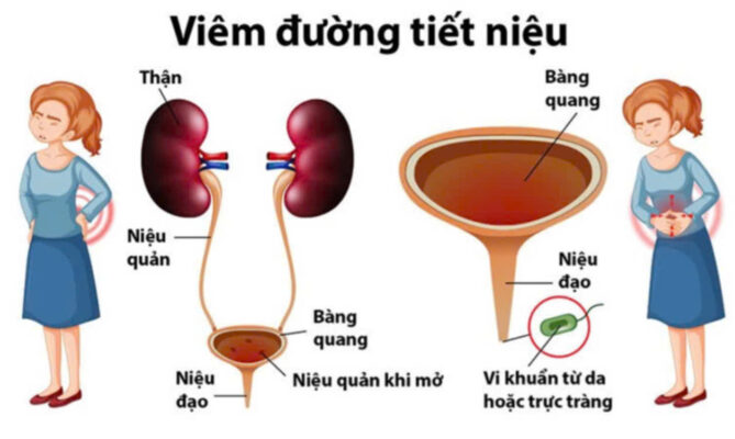 Nhiễm trùng đường tiết niệu ở phụ nữ tiền mãn kinh